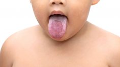 oralthrush
