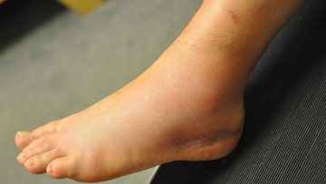 leg