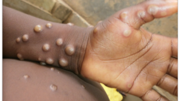 Monkey pox