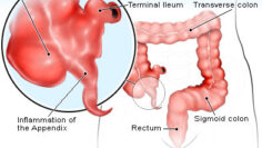 appendicitis