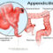 appendicitis