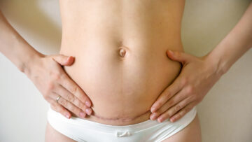things-to-avoid-after-c-section-2