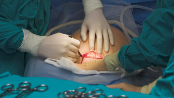 cesarean section birth