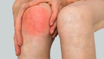 InfectiousArthritis_share