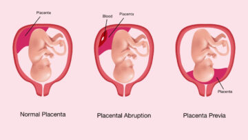 Placenta
