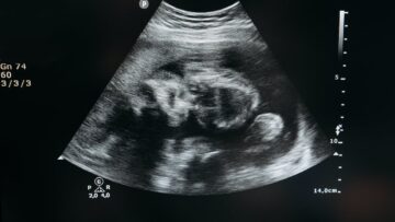 Ultrasound Scan In Pregnancy