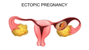 ectopic-pregnancy