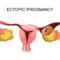 ectopic-pregnancy