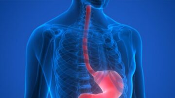 esophageal-conditions