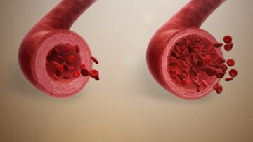 low blood volume
