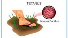 tetanus